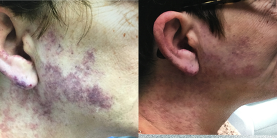 55-64 year old woman treated with Excel V - After two treatments with Cutera Excel V