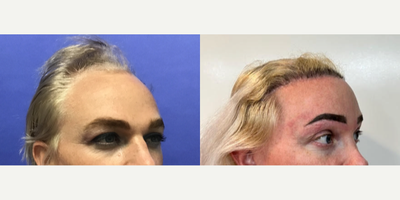 Patient treated with Brow Lift, Chemical Peel, Hair Transplant, Mole Removal, TCA Peel - 35 to 44 year-old female patient is 2 years post-op from Facial Feminization surgery. Her procedures included: Placement of Tissue Expander for Mayer Flap, Forehead Lift and Orbital Bony Contouring, Septorhinoplasty (closed) with Cartilage Grafts and Weirs, Cheek Implants (small), Chin Reduction and Contour, Subnasal Lip Lift with Fat Augmentation to Lips, Medium Facelift, 1cc Voluma and Juvederm, Periorbital TCA, and mole removals on face. Patient is 1.5 years post-op from Removal of Tissue Expander and Rotate Flap. Patient is 3 months post-op from Dog Ear Procedure, and 800 Micrografts to Hairline.