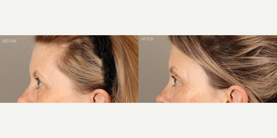 Temporal Brow Lift, Upper Blepharoplasty and Full-Face Fractionated CO2 Laser - 58-year-old female who was concerned about her eyes looking tired. She is shown 6 months after a temporal (lateral) endoscopic-style brow lift, upper blepharoplasty and full-face fractionated CO2 laser. The combination of surgeries created a more youthful upper eye contour, relieved tension on her forehead and refreshed her skin.