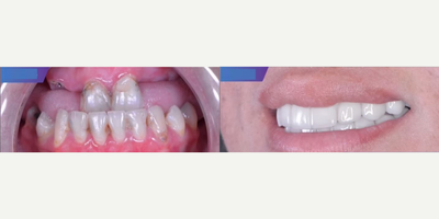 Woman treated with All-on-4 Dental Implants - Woman treated with All-on-4 Dental Implants.