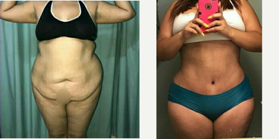 25-34 year old woman treated with Tummy Tuck - Tummy Tuck Liposculpture
