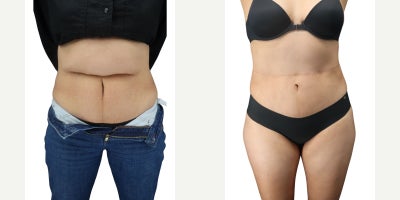 Woman treated with Tummy Tuck, Liposuction - Woman treated with Tummy Tuck, Liposuction