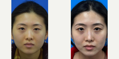 Woman treated with Asian Rhinoplasty - A subtle yet transformative augmentation Asian Rhinoplasty on our patient from NYC to build up her bridge using just cartilage from her septum.