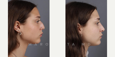 Woman treated with Rhinoplasty - Whether its correcting a deviated septum, refining the nasal tip, or straightening the bridge, rhinoplasty offers transformative results tailored to each individuals unique aesthetic goals.