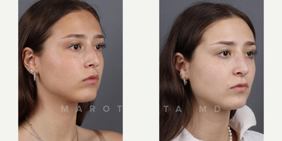 Woman treated with Rhinoplasty - Whether its correcting a deviated septum, refining the nasal tip, or straightening the bridge, rhinoplasty offers transformative results tailored to each individuals unique aesthetic goals.