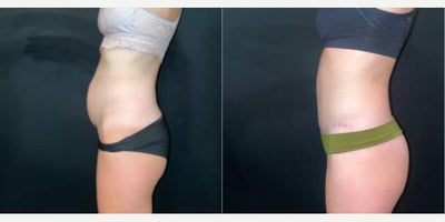 25-34 year old woman treated with Tummy Tuck, Umbilical Hernia Repair - This is a 33-year-old female who has concerns about her overhanging pannus and umbilical hernia. The procedure performed was an abdominoplasty with umbilical hernia repair. The photos show 9 months post-op.