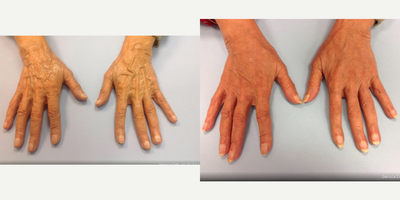 55-64 year old woman treated with Radiesse - Rejuvenation of aging hands with Radiesse