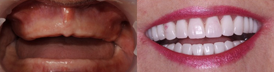 Permanent Teeth-in-1-Day Dental Implants - Female
Same Day Short recovery times
