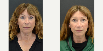 65-74 year old woman treated with CO2 Laser, Facelift, Lifestyle Lift, Lower Facelift, Neck Lift, SMAS Facelift - Patient had a lower face and neck lift with a CO2 laser.