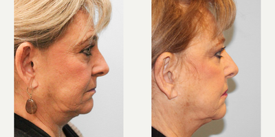 55-64 year old woman treated with Ear Surgery - This woman in her early sixties had insecurities surrounding the prominence of her ears and desired an otoplasty. She is shown before and one month after surgery.