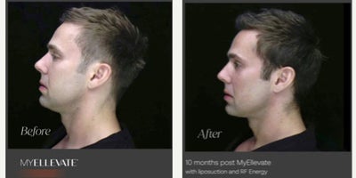 39 year old man treated with MyEllevate - MyEllevate with liposuction and RF Energy