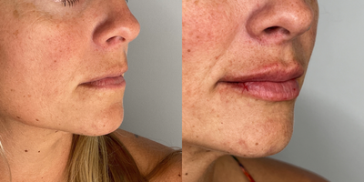 35-44 year old woman treated with Juvederm, Lip Fillers - Pt treated for lip augmentation with Juvederm ultra plus xc