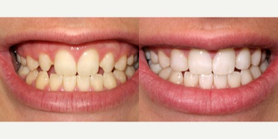 18-24 year old woman treated with Dental Bonding - With direct tooth bonding, a cosmetic dentist can fill grooves and gaps in your smile, and make it look better than new. Bonding is also excellent for replacing old fillings and reducing sensitivity at the gum line due to recession.

Bonding is tooth-colored plastic that the dentist applies to replace worn areas of your teeth and to build up areas where there should be tooth material.&nbsp;