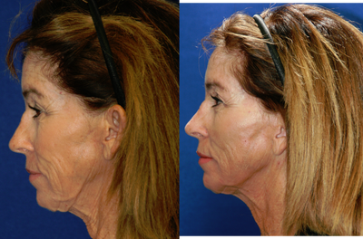 45-54 year old woman treated with Non Surgical Face Lift - Silhouette InstaLift - Silhouette InstaLift is a simple procedure to re-contour your face, lifting the deeper layers of your skin for a more youthful appearance.
Full Face and Neck