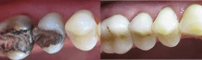 25-34 year old man treated with Brite Smile - 25-34 year old man treated with Brite Smile