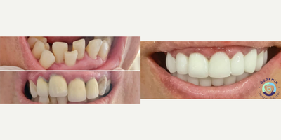 35-44 year old woman treated with Dental Bridge, Dental Implants, Smile Makeover, Dental Crown - Crown Type: ZirconiumShade: OM3