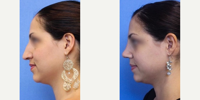 Woman treated with Nose Surgery - Woman treated with Nose Surgery