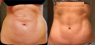 Woman treated with Renuvion - Woman treated with Renuvion. Beforeand 2 months post-op