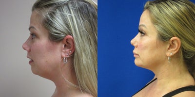 Chin - Neck Liposuction - Patient wanted to tighten up the tissue under her chin and neck.  Liposuction performed by Dr. Eric Schaffer.