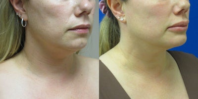 Chin - Neck Liposuction - Patient wanted to tighten up the tissue under her chin and neck.  Liposuction performed by Dr. Eric Schaffer.