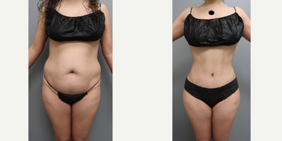 35-44 year old woman treated with Tummy Tuck, Brazilian Butt Lift, Mommy Makeover - This patient had quite a bit of rectus muscle stretching, stubborn fat around the front and back, and wanted more butt and hips. She had flat hips and a small butt overall for her frame. We did a BBL Tummy tuck combo on her (with lipo 360, and muscle repair) and here she is 4 months postop with quite a bit of difference.