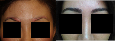 Before and after excision of eyebrow scars with subsequent eyebrow transplant of 700 grafts - Procedure details: Patient developed scarring in both eyebrows the result of attempting to chemically peel a prior tattoo. This was a challenging case that was successfully treated in two stages: the first stage was excision of both eyebrow scars using a plastic surgery technique, followed 6 months later with eyebrow transplants.