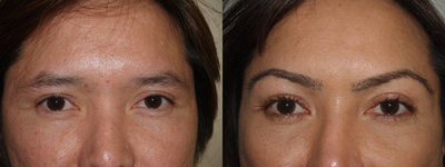 Eyebrow transplant - Eyebrow transplantation