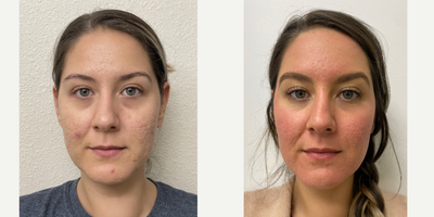 BRIDE BEAUTY BY EMER | ACNE SCAR COMBO - My patient has some deep ice pick scars that have bothered her for a long time now and she decided it was time to change that. She wants to have a beautiful even texture throughout her skin which is something she hasn't had since early in life. She is getting married soon and wants to have smoother skin for her big day. For her case, her scars are very severe and will take many treatments to get her to her goals. This was her first treatment and we saw a good improvement and plan to do another treatment next time we are in Miami. In between treatments she will be doing chemical peels to keep the skin rebuilding WOULD YOU LIKE TO IMPROVE YOUR SKIN?