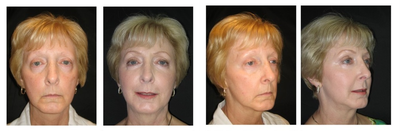Liquid Facelift  - 