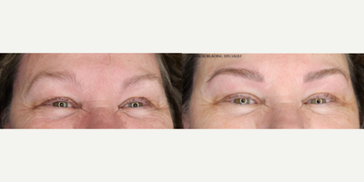 Woman treated with Microblading - Woman treated with Microblading