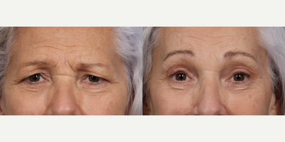 71 year old woman treated with Brow Lift - Endoscopic Browlift and Upper Eyelid Blepharoplasty