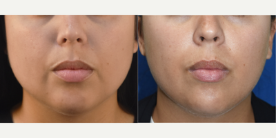 Botox for TMJ and jaw slimming before and after injections. - Patient is a young female that was bothered by headaches and daily jaw aches from overactive teeth clenching and jaw grinding. For many, this is an unconscious process (especially at night) that can lead to jaw pain, teeth problems, migraines and premature lower face aging. Less than one month after Botox (Dysport), you can see a dramatic reshaping of the patients lower face and her headaches and jaw aches were gone.