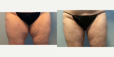 45-54 year old female  treated with Body-Jet Liposuction to the Inner thighs - Patient suffered from excessive fat located only in her inner thighs. She was otherwise happy with her body weight and shape. Dr. Falcone performed Body Jet liposuction, Water-assisted liposuction to her inner thighs. This procedure was done under local anesthesia. Body Jet liposuction offers superior sculpting capability for the buttocks and legs. Dr. Falcone has performed Body Jet Liposuction since it was first released over 15 years ago treating thousands of patient from the face to the ankles.