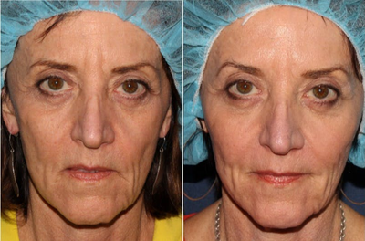 55-64 year old woman treated with Voluma - Female patient treated with Voluma to restore volume to the cheek area.