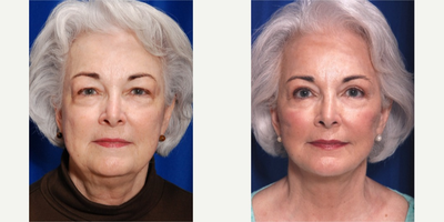 Facelift - New Orleans - Face and neck lift along with submental liposuction and lipo contouring