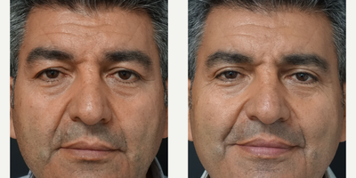 55-64 year old man treated with Eyelid Surgery - Eyelid Surgery  on a single session performed by Ozge ERGUN, MD4 Months Post Operative