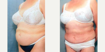 Woman treated with Tummy Tuck - Woman treated with Tummy Tuck through removal of excess skin along with muscle tightening.