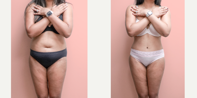 35-44 year old woman treated with Tummy Tuck, Tumescent Liposuction - This patient underwent a tummy tuck with 360 Liposuction and is shown 2 months post-op. These procedures can be combined safely to create a beautiful, contoured midsection that can be appreciated from all angles.