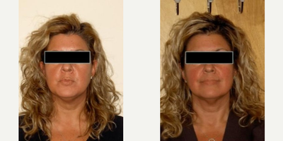 Woman treated with Titan Laser - 16 weeks post Titan, Restylane, Botox