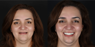 25-34 year old woman treated with Dental Bone Graft, Dental Implants - 34 years old lady had lost her upper and lower teeth and we have made her dental implant treatment. Her happiness in her eyes can be seen just after we deliver her fixed implant supportes prostheses.