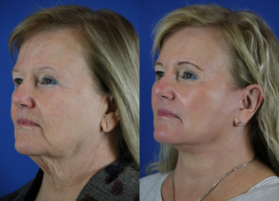 67 year old woman treated with Facelift - This patient presented with concerns related to marked neck laxity, sagging jowls, deep marionette lines and nasolabial folds, and wrinkling of the facial skin. She underwent facelift, autologous fat grafting for restoring midface volume, and CO2 laser skin resurfacing. As demonstrated in her postop pictures, she has had marked improvement in her neck and jawline, significant reduction in the depths of the nasolabial folds and marionette lines, and improvement in the tone and texture of the skin giving a natural, more youthful appearance.