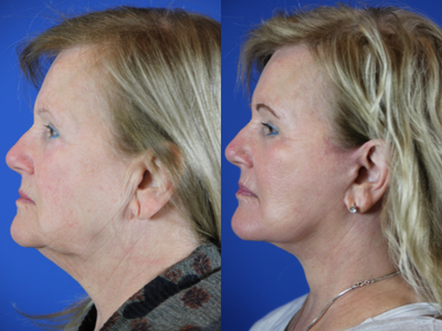 67 year old woman treated with Facelift - This patient presented with concerns related to marked neck laxity, sagging jowls, deep marionette lines and nasolabial folds, and wrinkling of the facial skin. She underwent facelift, autologous fat grafting for restoring midface volume, and CO2 laser skin resurfacing. As demonstrated in her postop pictures, she has had marked improvement in her neck and jawline, significant reduction in the depths of the nasolabial folds and marionette lines, and improvement in the tone and texture of the skin giving a natural, more youthful appearance.
