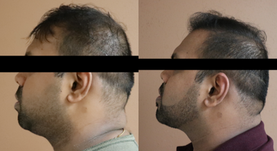 25-34 year old man treated with Chin Liposuction - This gentleman desired a stronger jawline and chin as well as treatment for excess fat of the midface andneck. He underwent chin augmentation with silicone implant combined with buccal fat pad removal andsubmental liposuction (neck).
