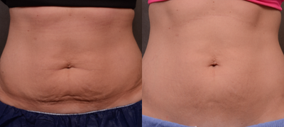 25-34 year old woman treated with Profound Sub-Q - 3 months after one treatment with Profound SQ for skin laxity and a modest abdominal pouch