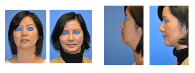 Asian Rhinoplasty, Genioplasty, Submental Liposuction, Juvaderm to Beneath Eyebrows - This women desired a face lift / neck lift.  She wanted a rhinoplasty.  She wanted a upper blepharoplasty.  After an in depth consultation, it became clear that her goal for the face lift was to create a distinction between her neck and face.  I am not against doing facelifts in the 40 year old population - but in her case I felt she could better achieve her desired result with genioplasty and submental liposuction.  We also did an Asian rhinoplasty with rib graft.  Finally, her desires for her blepharoplasty were to lift up the upper eyelid skin very subtly.  So I suggested the juvaderm to the eyebrows (this is great little procedure which can also be done with fat grafting).  With that said these results are relatively early - I have included them to show how quickly one can recover and will update them in time.
