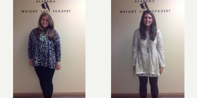 25 year old woman treated with Sleeve Gastrectomy - Out patient sleeve gastrectomy.