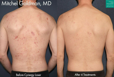 Man treated with Pulsed Dye Laser - Cynergy laser to treat port wine stain on neck by Dr. Goldman.