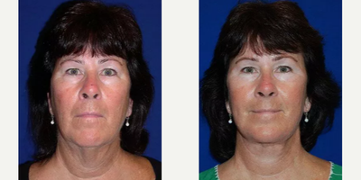 Woman treated with Brow Lift - Woman treated with Brow Lift