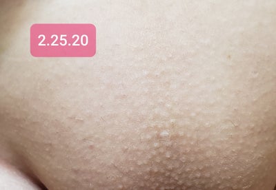 Brazilian hair removal zap review sale