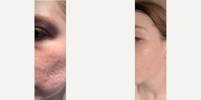Woman treated with MiXto Laser, Venus Viva - Details - Acne treated with lasers and fillers